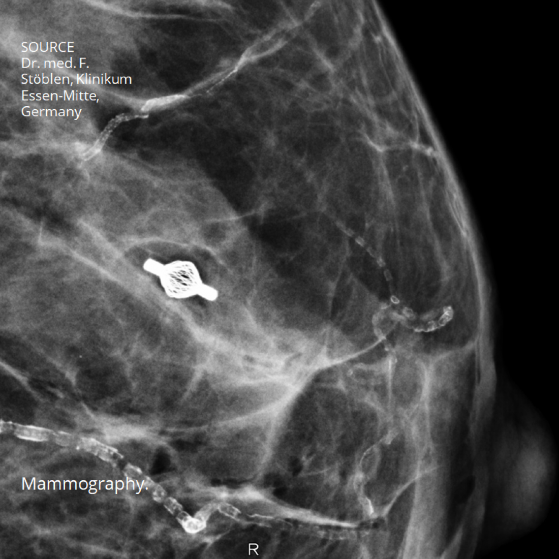 Breast Tissue Clip Marking – VIRA MEDICAL